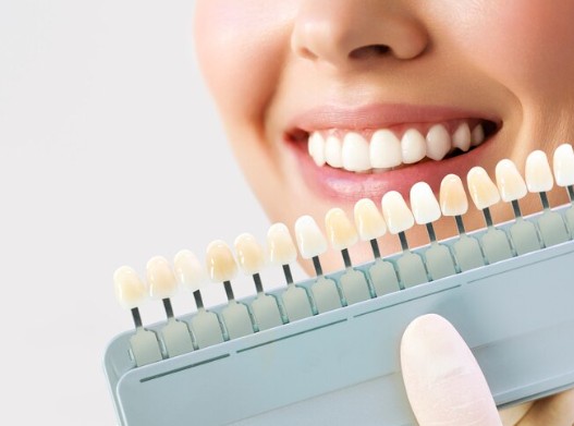 Faccette Dentali