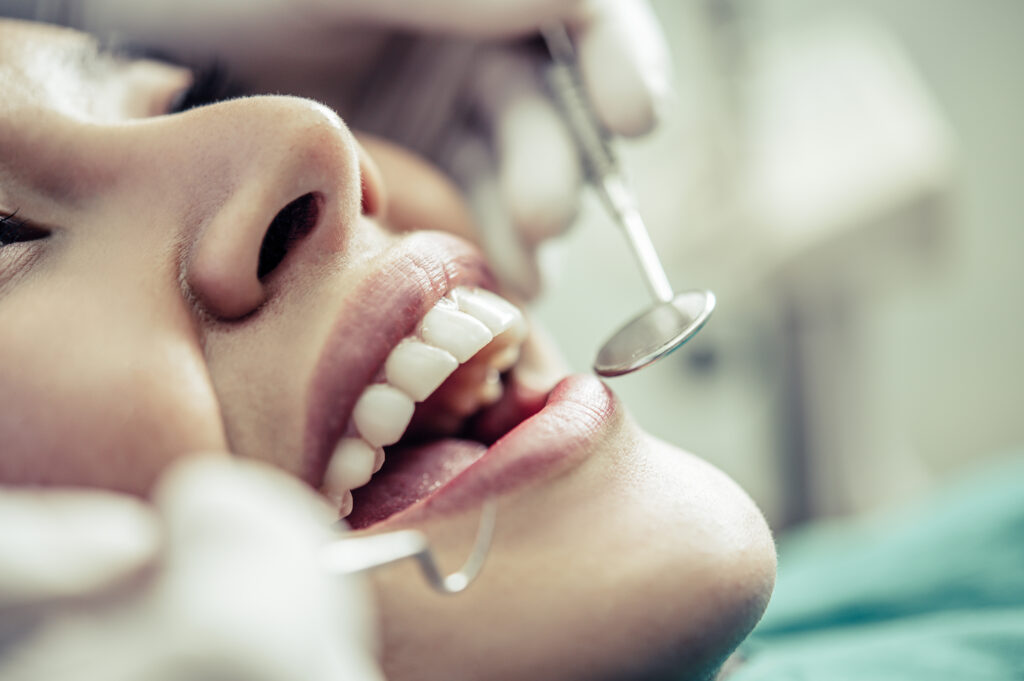 Sbiancamento dentale