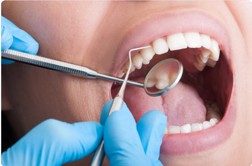 Pulizia Denti Professionale